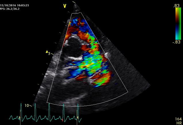 Turbulente flow was zichtbaar in de arteria pulmonalis (figuur 2B) en er werd een verhoogde snelheid gemeten van 4,57 meter per seconde, dit komt overeen met een drukgradiënt van 83,64mmHg.