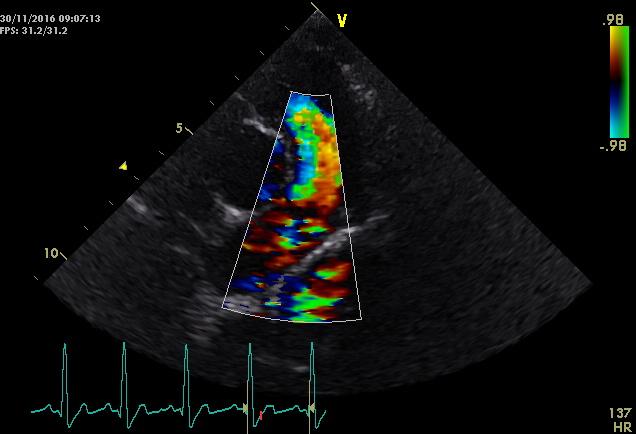 aortainsufficiëntie aanwezig en op het mitralisinstroomprofiel was de E/A golf gefusioneerd en werd een snelheid van 0,73 meter per seconde gemeten.