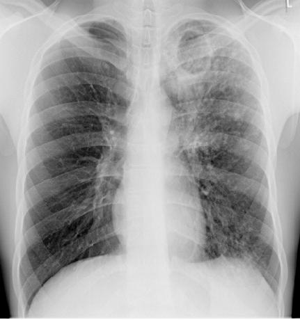 5.2.3 Röntgenonderzoek van de thorax Thoraxfoto De thoraxfoto is een diagnostisch hulpmiddel bij de patiënt die verdacht wordt van intra-thoracale tuberculose.