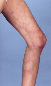 3 BESCHRIJVING CMTC Cutis Marmorata Telangiectatica Congenita (CMTC), ook wel Van Lohuizen syndroom genoemd, is een zeer zeldzame huidaandoening waarbij de verwijde bloedvaatjes door de huid