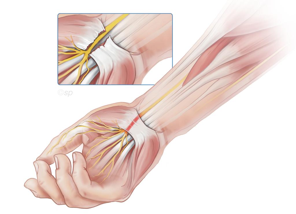 De operatie De hand wordt plaatselijk verdoofd door een inspuiting in de handpalm of pols. Het gevoel in de vingers blijft vaak aanwezig.