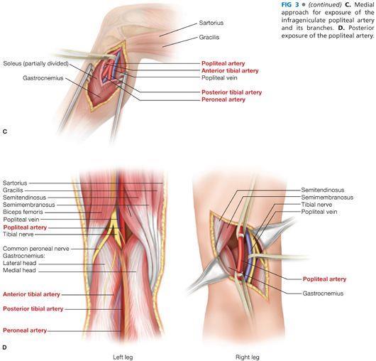 2. Arteria poplitea infragenuaal (P3) - Thrombus onderbeensarteriën -Noodzaak tot volledig