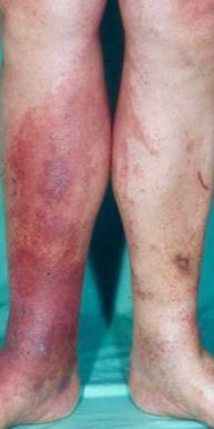 Eczeem - Bruinverkleuring huid okerdermatitis - Verharding huid (lipo en dermatosclerose- -