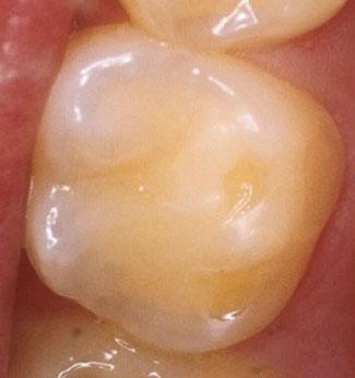 a b Afb. 4. a. Een eerste molaar van een patiënt van 16 jaar met pijnklachten tijdens eten. Sonderen van het blootliggende dentine op de knobbel gaf pijnreactie. b. Een eerste molaar van een ongeveer 30-jarige vrouw.