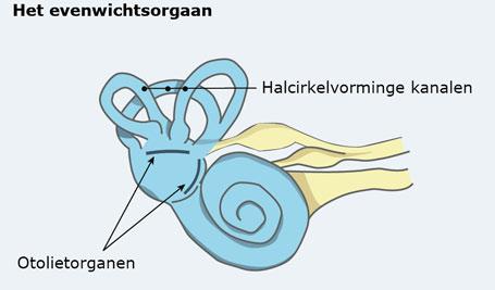 Dat kan door een éénmalig (>100 decibel) of herhaaldelijke (>80 decibel) blootstelling geschieden. Deze schade is onherstelbaar en het gevolg zal een "dip" op die frequentie zijn.