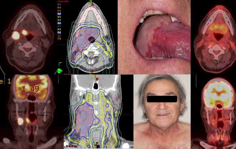 PT for Nasopharynx/Oropharynx Ca 50%+