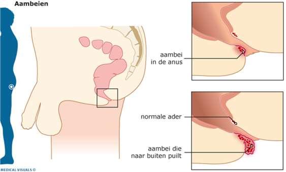 Wat zijn aambeien? Aambeien zijn eigenlijk een soort spataderen. Ze zitten alleen op een vervelende plaats: binnen de sluitspier van de anus. Het zijn uitgezakte zwellichamen bij de anus.