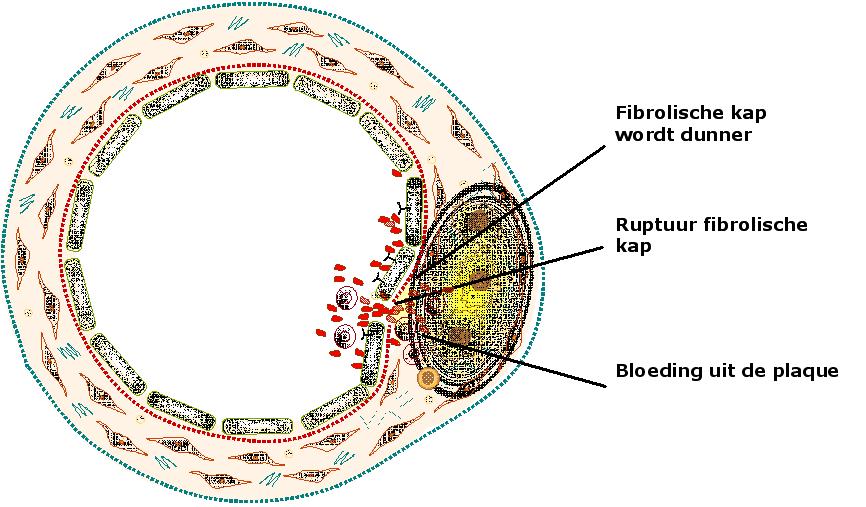 Instabiele Atherosclerotische