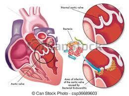 * wat is endocarditis?