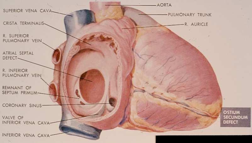 ASD 2 ASD type sinus venosus ASD