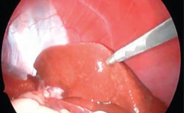 (Tru-Cut) Laparotomie Laparoscopie Belangrijk: pre-operatieve controle coagulatie Pre-operatief toedienen vit K/plasma indien nodig Complicaties Bloeding Vagotone shock