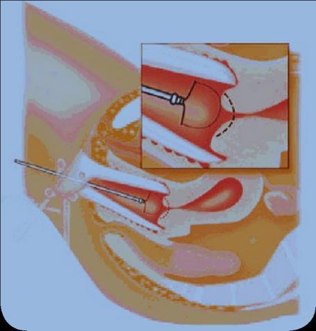 Conisatie Een conisatie lijkt op een lis excisie. Bij deze ingreep verwijdert de gynaecoloog het kegelvormige stukje baarmoedermond met een mesje.