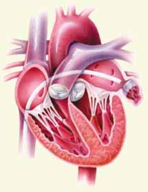 Als u in slaap bent, wordt de lies aangeprikt. Een lang flexibel buisje of katheter wordt ingebracht in een groot bloedvat in de lies en opgeschoven tot in de rechtervoorkamer van het hart.