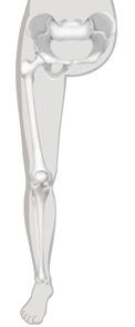 Heupexarticulatie Bij een heupexarticulatie wordt bij de operatie het volledige been weggenomen. Het bovenbeen wordt uit de heup genomen. Het aansturen van de prothese gebeurt vanuit de heup.