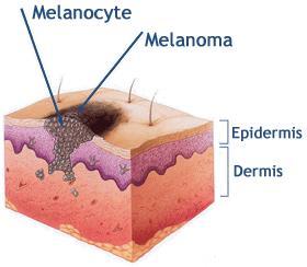 Melanoom - kwaadaardige moedervlek melanocyt melanoom epidermis dermis - maligne melanocyten - meestal de