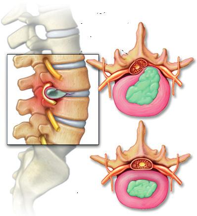tussenwervelschijf met hernia normale tussenwervelschijf naar de enkel en de voet, soms bandvormig rond de enkel.