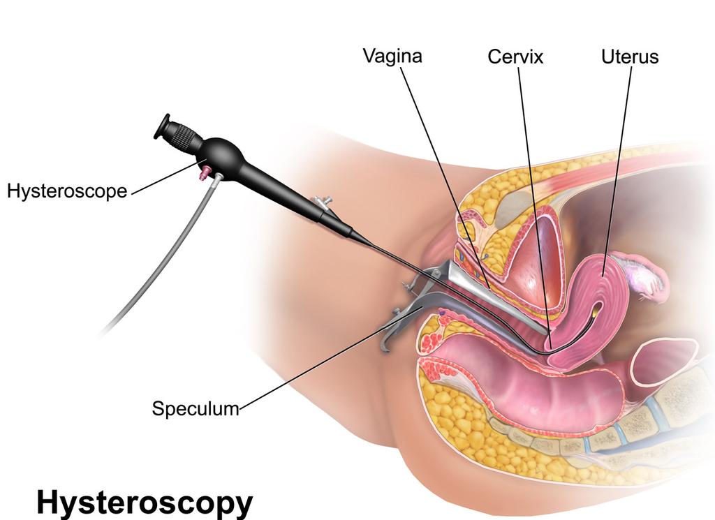 WAT IS EEN AMBULANTE HYSTEROSCOPIE? Hysteroscopie betekent letterlijk in de baarmoeder kijken.