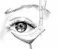 de oogkas wordt vastgehecht. Deze operatie heet: 'laterale tarsale strip procedure'.