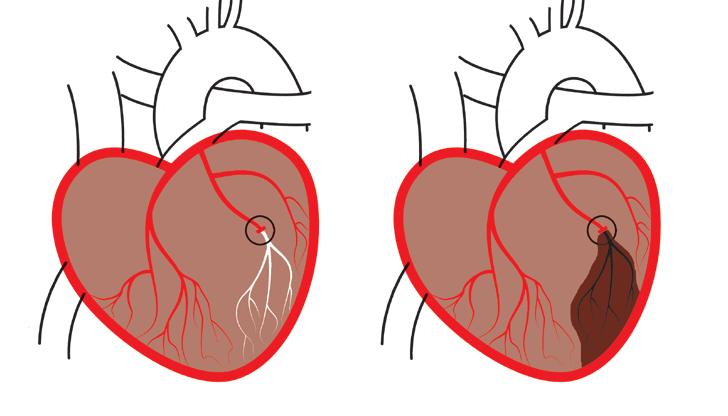 Wat is een hartinfarct? Een hartinfarct treedt op doordat een kransslagader afgesloten raakt. Als de plaque in het bloedvat scheurt, ontstaat een bloedstolseltje.