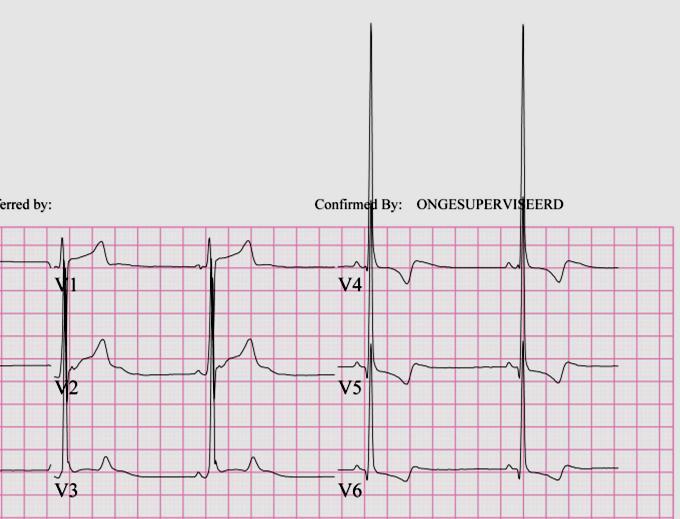 6 QRS morfologie pathologische Q golven?