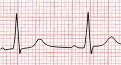 6 QRS morfologie pathologische Q golven? LVH / RVH? microvoltages?