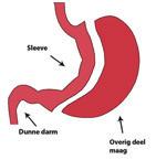 diarree. Door aanpassing van uw voeding kan dit vaak vermeden worden. Dit fenomeen is vaak slechts tijdelijk en treed voornamelijk op tijdens het eerste jaar na chirurgie.