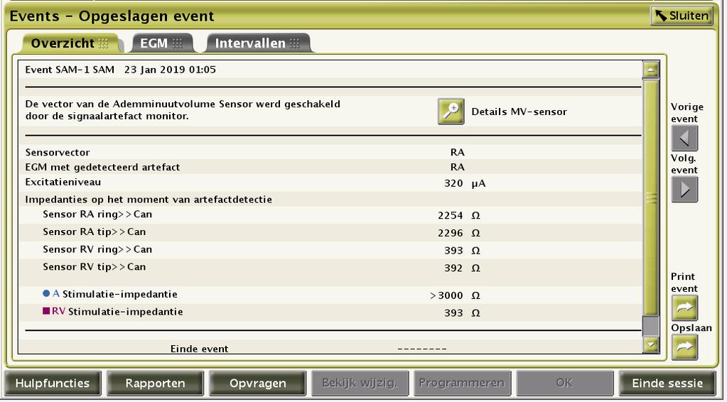 elektrode of de elektrodeverbinding is (zie tabel 3). Tabel 3. Voorbeeld van een Signal Artifact Monitor-episode met bijbehorende vector en elektrodeimpedantiewaarden.