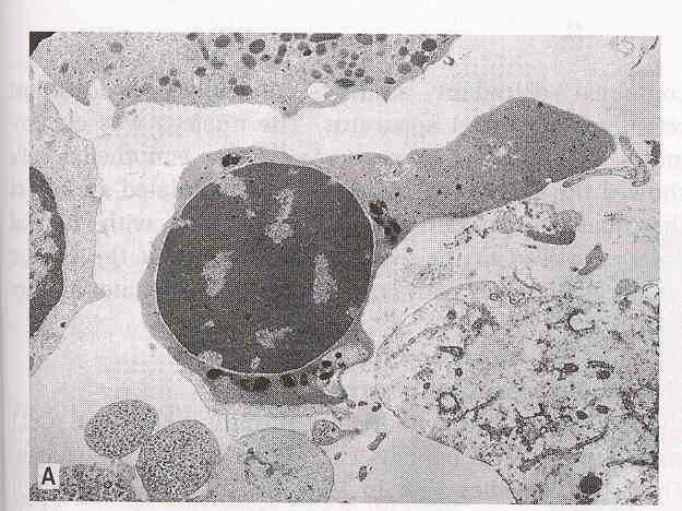 EM-foto van ringsideroblast Ringsideroblasten in ijzerkleuring