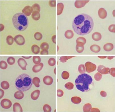 van: Dosis Type Medicatie Tijdsduur Poikilocytose, anisocytose Basofiele stippeling, Howell Joly Pseudo Pelger (Taxol),