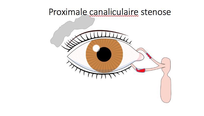Volledige stenose canaliculi: Jones buis: bypass tussen de mediale ooghoek en neusholte.