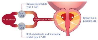Prostate volume predicts outcome of treatment of BPH with finasteride. Boyle P. Urology 1996;48:398-405.