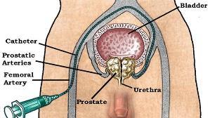 Journal of Vascular and Interventional Radiology, 2017, Volume 28, Issue 2, S 3. Prostatic Artery Embolisation Via endo-arteriële weg (a.