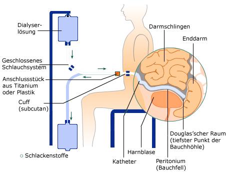 peritoneaal dialyse = thuis peritoneaal dialyse = thuis