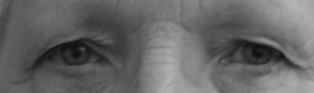 Behandeling: blepharoplastie De ooglidcorrectie bestaat uit het verwijderen van het teveel aan huid. Hoeveel er moet worden verwijderd, varieert per patiënt.