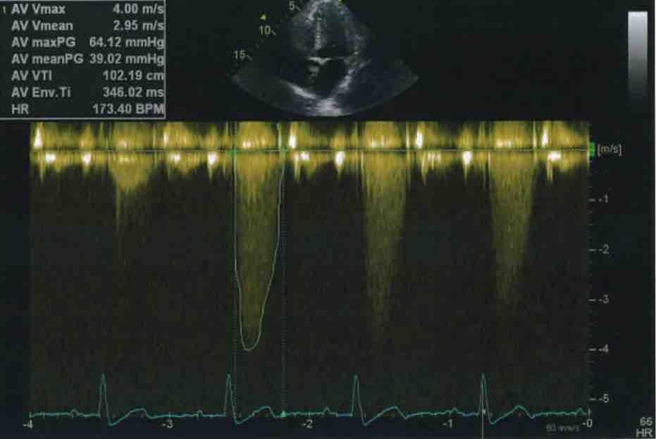 aortaklepstenose echocardiografie FUNCTIONELE afwijking van de aortaklep Doppler onderzoek
