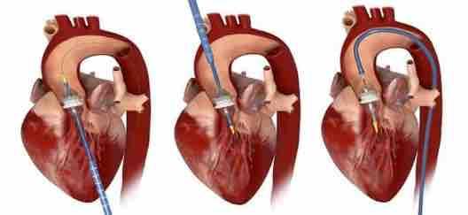 percutane aortaklepimplantatie TAVI