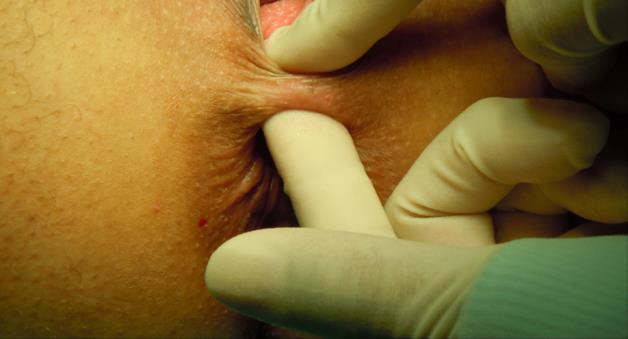 Diagnostiek: inspectie vulva, perineum, anus Positie patiënt positie: supine, li.