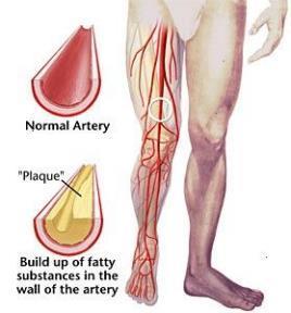 Arteriële insufficiëntie Arteriële insufficiëntie: onvoldoende bloedtoevoer naar het door een bepaalde slagader