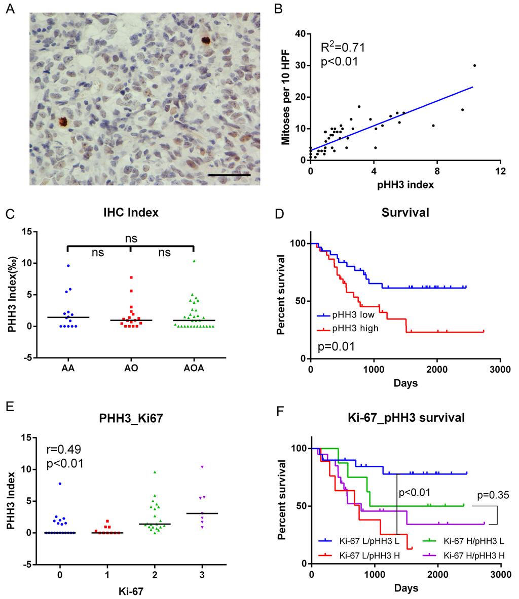 Figure 1: IHC data in anaplastic diffuse gliomas. A.