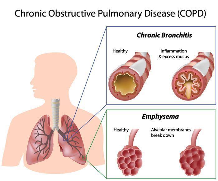Ziektebeeld De chronische luchtstroombeperking bij COPD wordt veroorzaakt door een combinatie van obstructie in de kleine