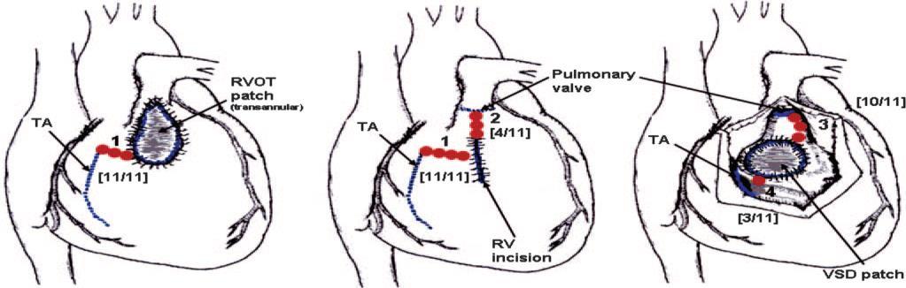 Nut van onderzoek Tetralogie van Fallot Preventieve hartkatheterisatie om een elektrische