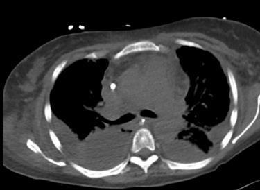 lact 2,2 K 6,5 kreat 300 fosfaat 4,6 echo cor goede functie werkdiagnose: