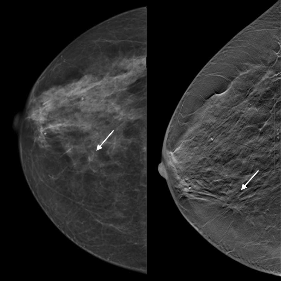 CHAPTER 1. INTRODUCTION 13 Figure 1.2: Visualization of a spiculated mass in digital mammography (left) and breast tomosynthesis (right).