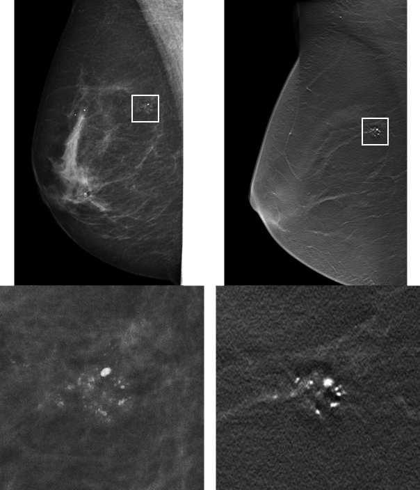 CHAPTER 1. INTRODUCTION 14 Figure 1.3: Visualization of a microcalcification group in digital mammography (left) and breast tomosynthesis (right).