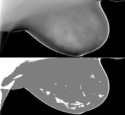 tissue for a patient with compressed breast thickness of 74 mm. Figure 2.