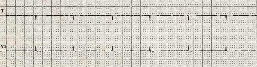 Kan je sterven met een pacemaker / ICD?