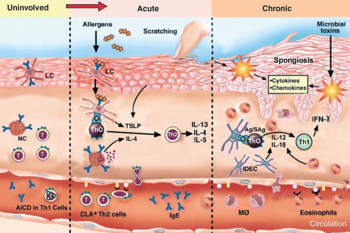 LC, Langerhans cell; MC, mast cell; TSLP, human thymic stromal lymphopoietin; Ag, antigen; SAg, superantigen; AICD, activation-induced cell death; CLA, cutaneous lymphocyte antigen; MO, monocyte.