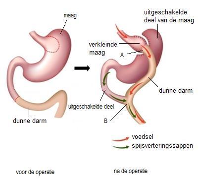 Afbeelding 2: Tijdens de operatie wordt punt A (uiteinde van de verkleinde maag) vastgemaakt aan punt B van de dunne darm.