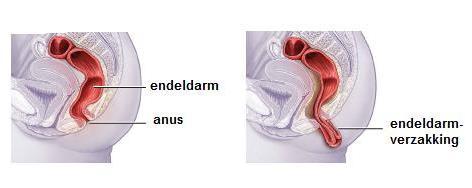 d) endeldarmverzakking (rectumprolaps of procidentia recti) Bij de volledige endeldarmverzakking (rectumprolaps) en de onvolledige endeldarmverzakking (recto-rectale intussusceptie) is er sprake van