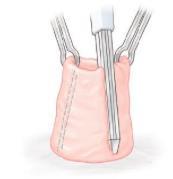 Colostomie Tijdelijk stoma : herstel continuiteit Definitief stoma Loop > eindstandig intraluminal bowel fixation modified